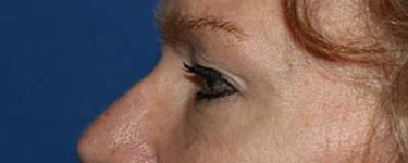 After Results for Blepharoplasty