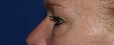 Before Results for Blepharoplasty