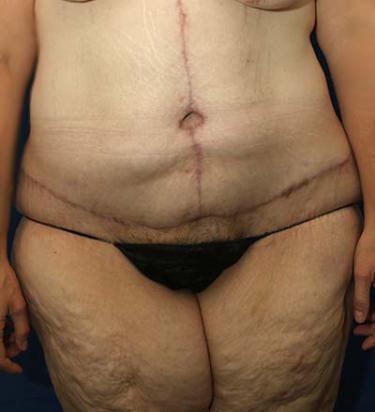 After Results for Panniculectomy