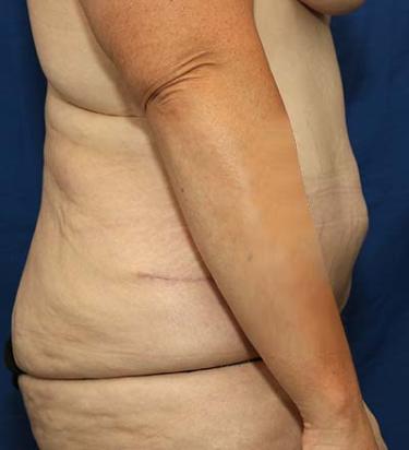 After Results for Panniculectomy