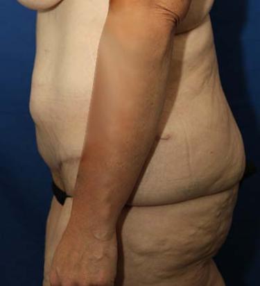 After Results for Panniculectomy