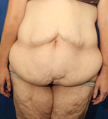 Before Results for Panniculectomy