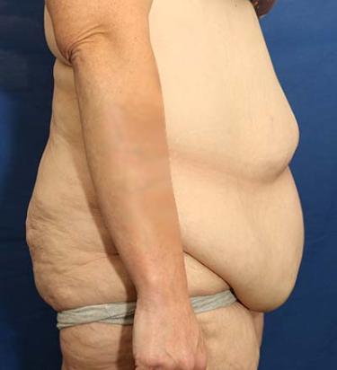 Before Results for Panniculectomy