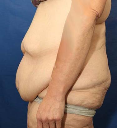 Before Results for Panniculectomy