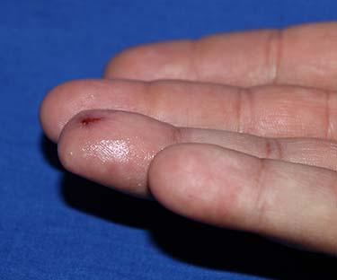 After Results for Wound Care