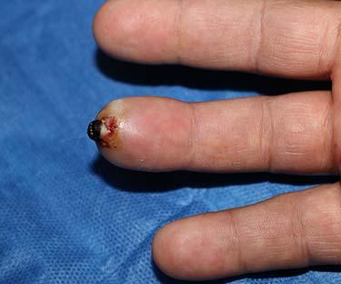 Before Results for Wound Care