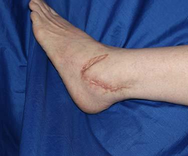 After Results for Wound Care