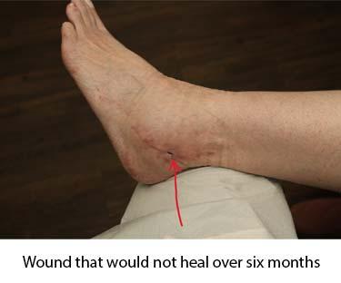 Before Results for Wound Care