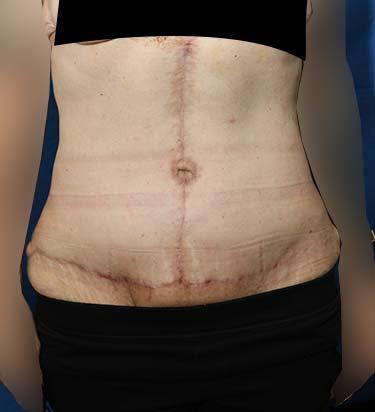 After Results for Panniculectomy