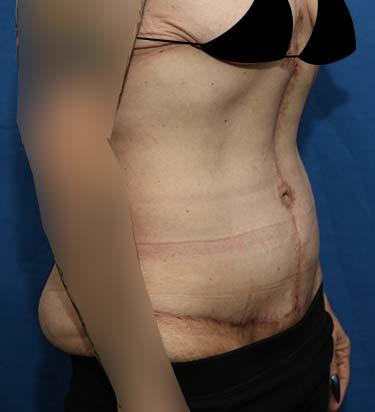 After Results for Panniculectomy
