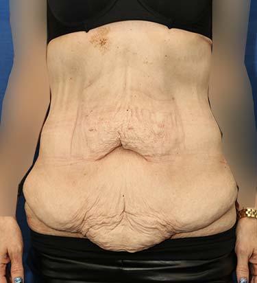 Before Results for Panniculectomy