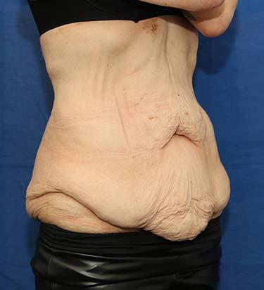 Before Results for Panniculectomy
