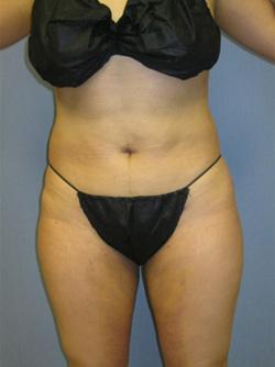 After Results for Liposuction