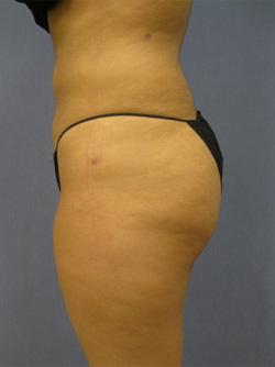 After Results for Liposuction