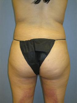 After Results for Liposuction