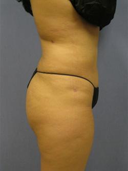 After Results for Liposuction