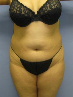 Before Results for Liposuction