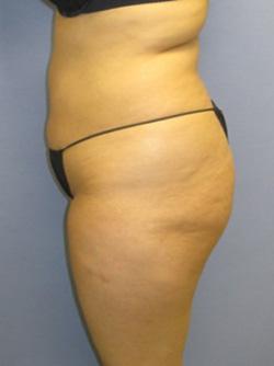 Before Results for Liposuction