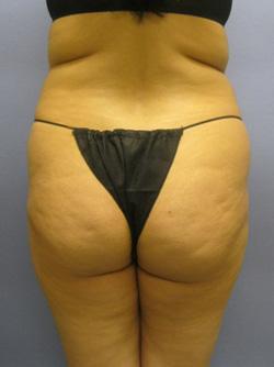 Before Results for Liposuction