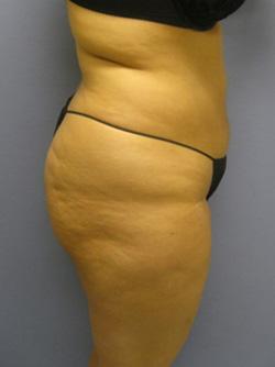 Before Results for Liposuction