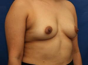 Before Results for Breast Augmentation