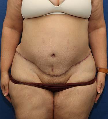 After Results for Panniculectomy