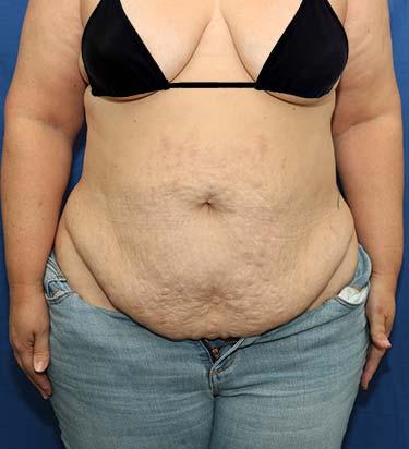 Before Results for Panniculectomy