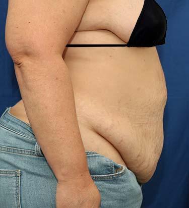 Before Results for Panniculectomy