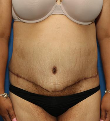 After Results for Panniculectomy