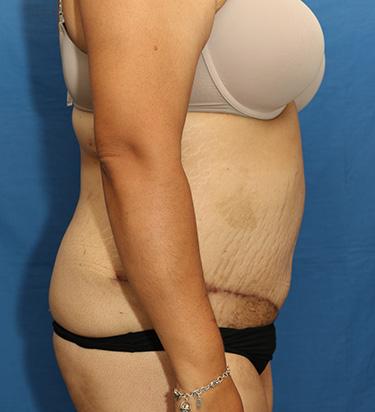 After Results for Panniculectomy