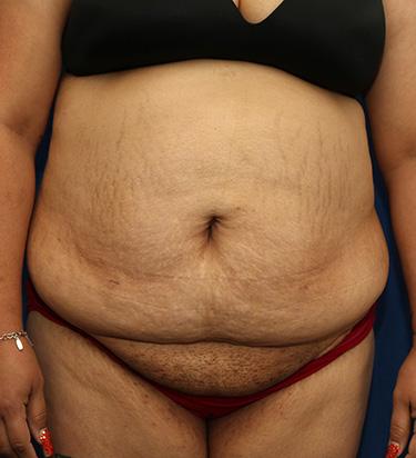 Before Results for Panniculectomy