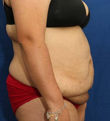 Before Results for Panniculectomy