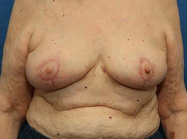After Results for Breast Reduction