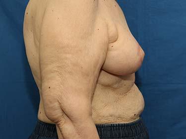 After Results for Breast Reduction