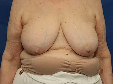 Before Results for Breast Reduction
