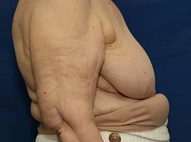 Before Results for Breast Reduction