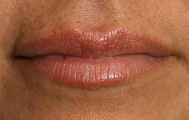 After Results for Tissue Fillers, Lip Augmentation