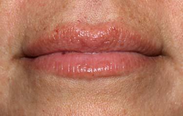 Before Results for Tissue Fillers, Lip Augmentation