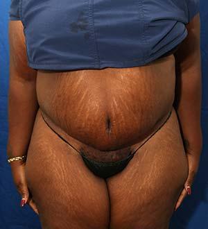 After Results for Panniculectomy