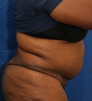 After Results for Panniculectomy