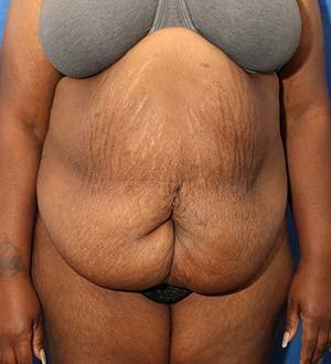 Before Results for Panniculectomy