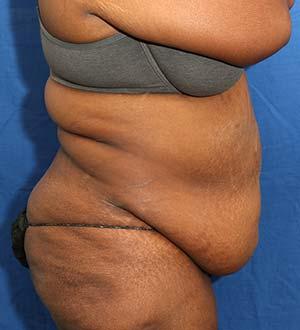 Before Results for Panniculectomy