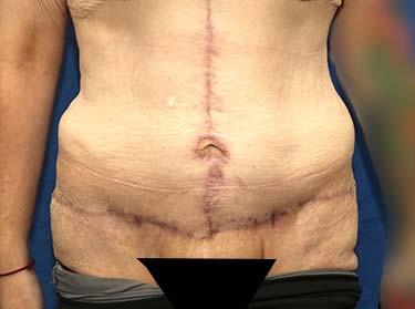After Results for Panniculectomy