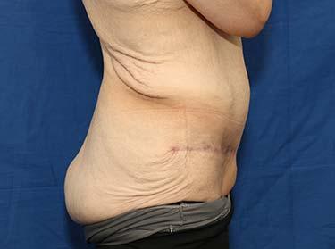 After Results for Panniculectomy