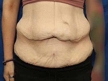 Before Results for Panniculectomy