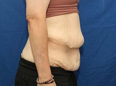 Before Results for Panniculectomy