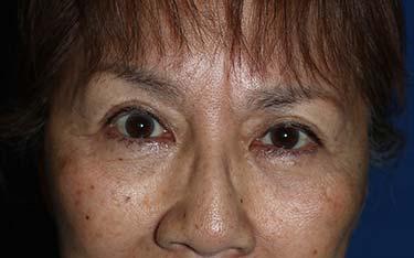 After Results for Blepharoplasty