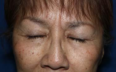 After Results for Blepharoplasty