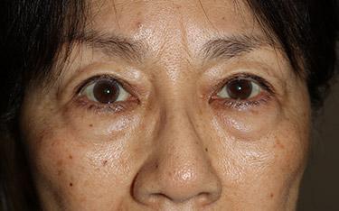 Before Results for Blepharoplasty