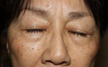 Before Results for Blepharoplasty